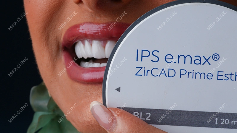 E-max Veneers